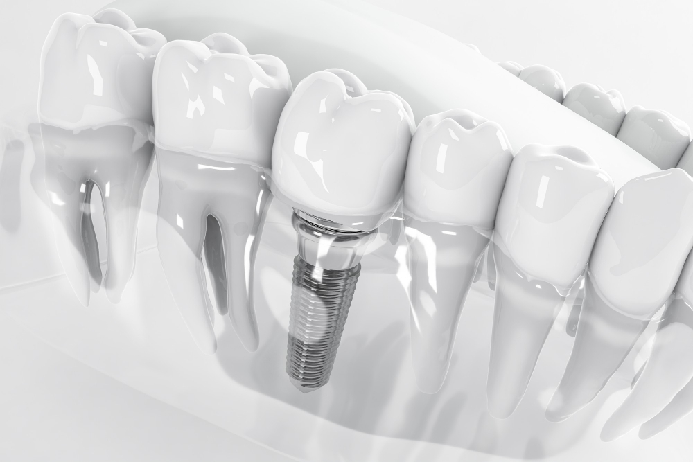 dental-implants-turkey