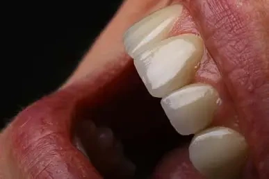veneers-istanbul